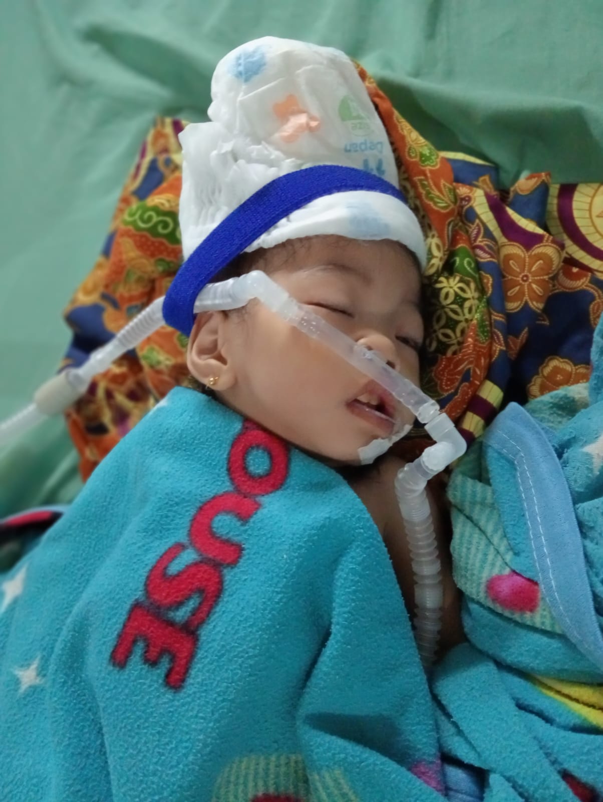  Afifah Azzahra, Balita berusia 1 tahun 6 bulan, yang tengah berjuang melawan penyakit epilepsi dan laringomalasia